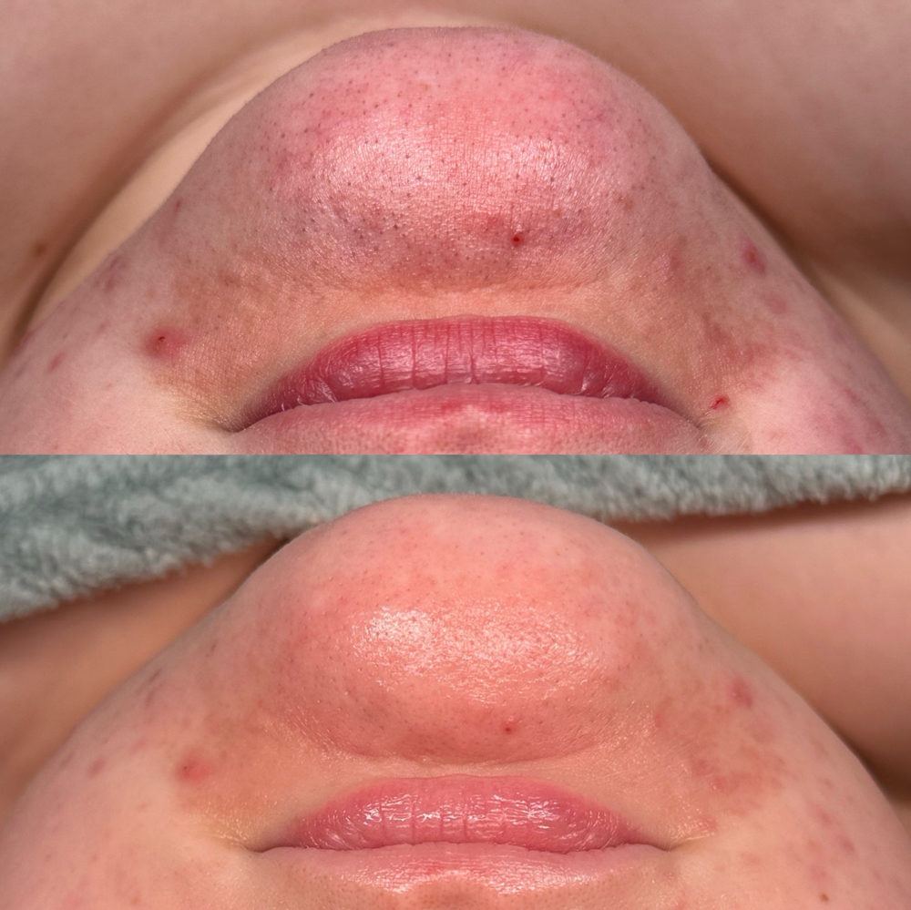 Deep Cleanse Treatment