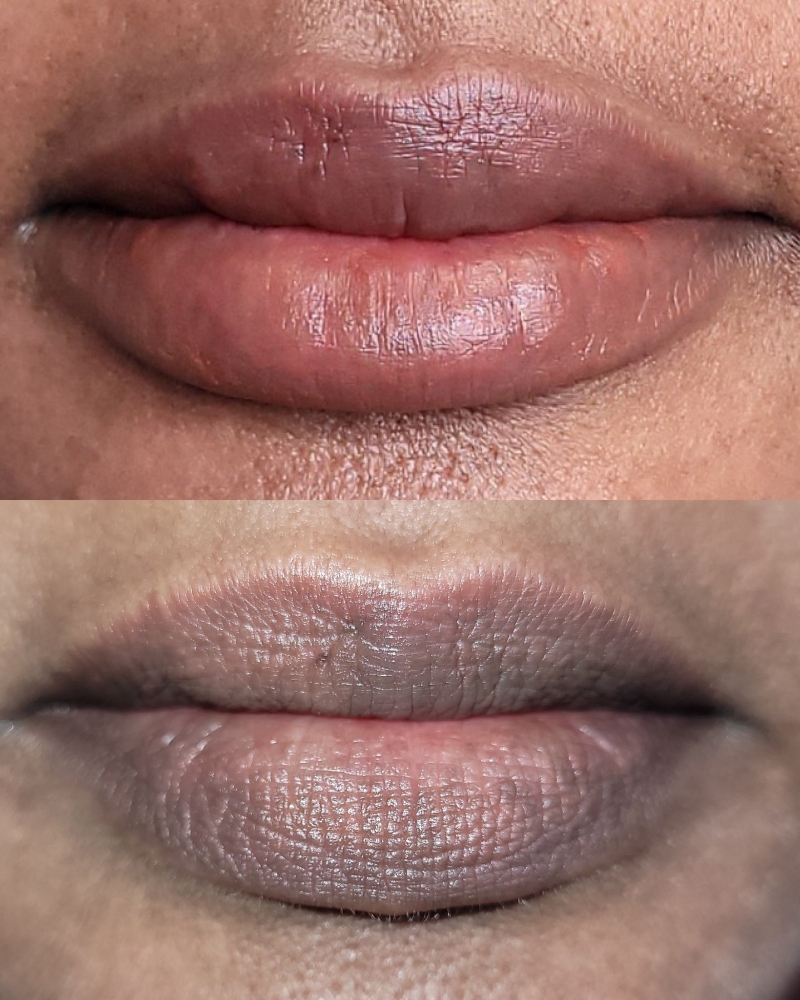 Lip Neutralization (Session Add-on)