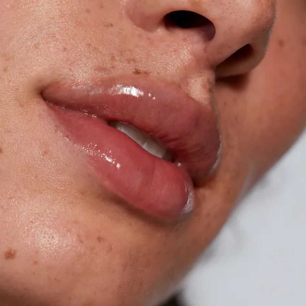 Juvederm Mini Lip Plump at Labios De Seda Medspa in El Paso, TX
