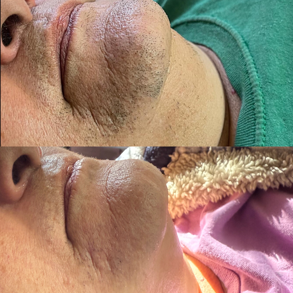 ICELHC Hair Reduction