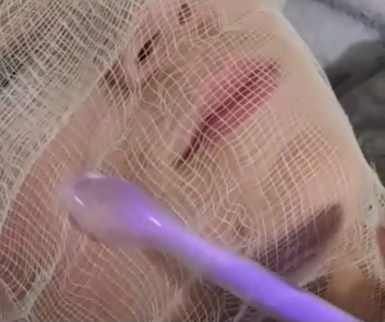 High Frequency Facial