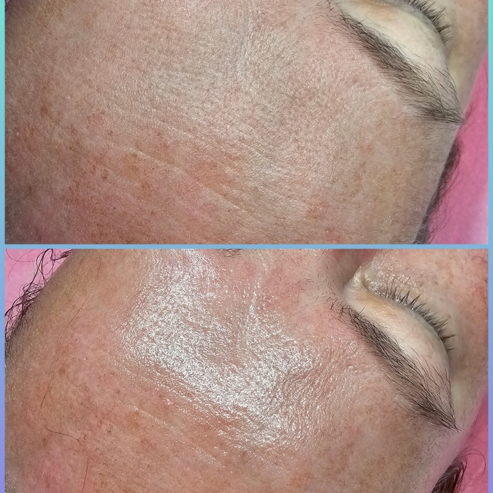 The Microdermabrasion Facial at Aligned Beauty & Wellness in Davenport, IA