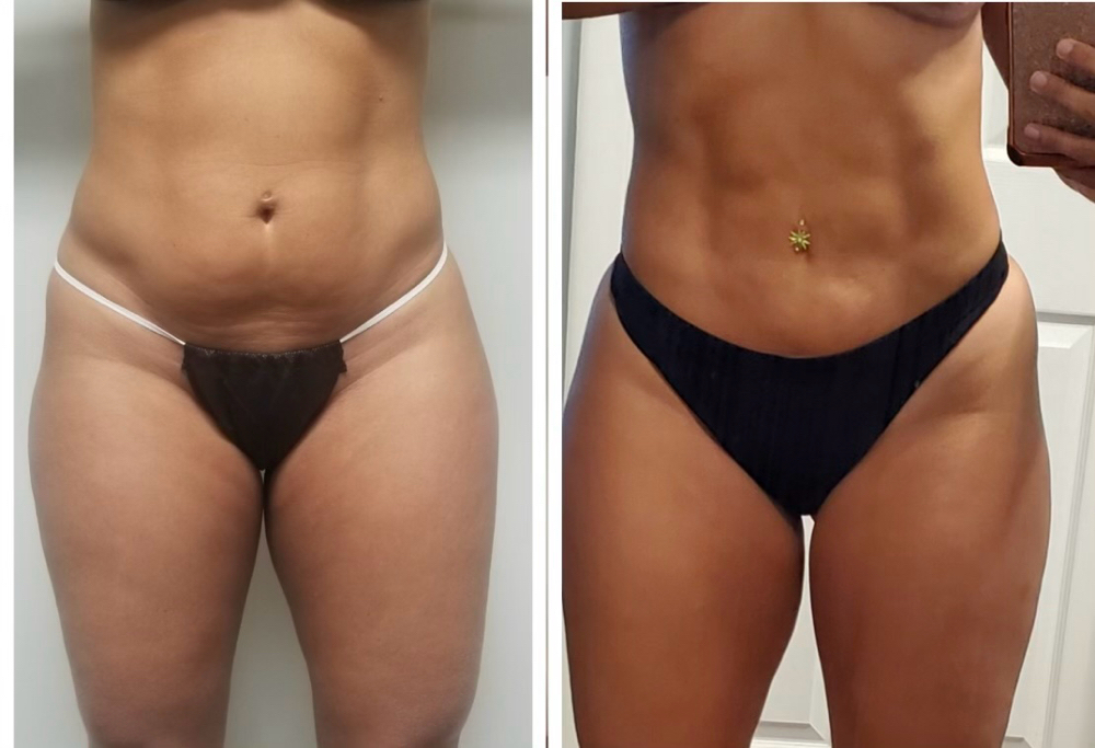 Wood Therapy/ Body Sculpting at Bliss Med Spa in Riverside, IL