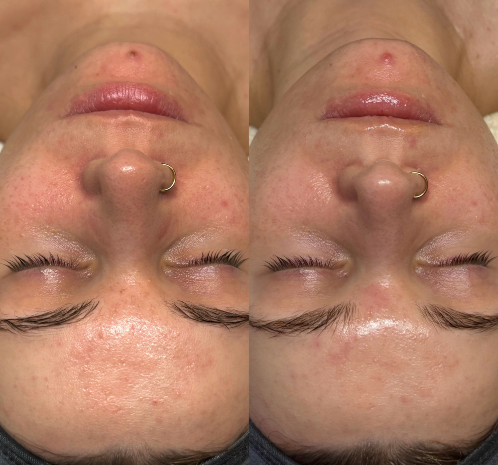 Oxygen Acne Facial