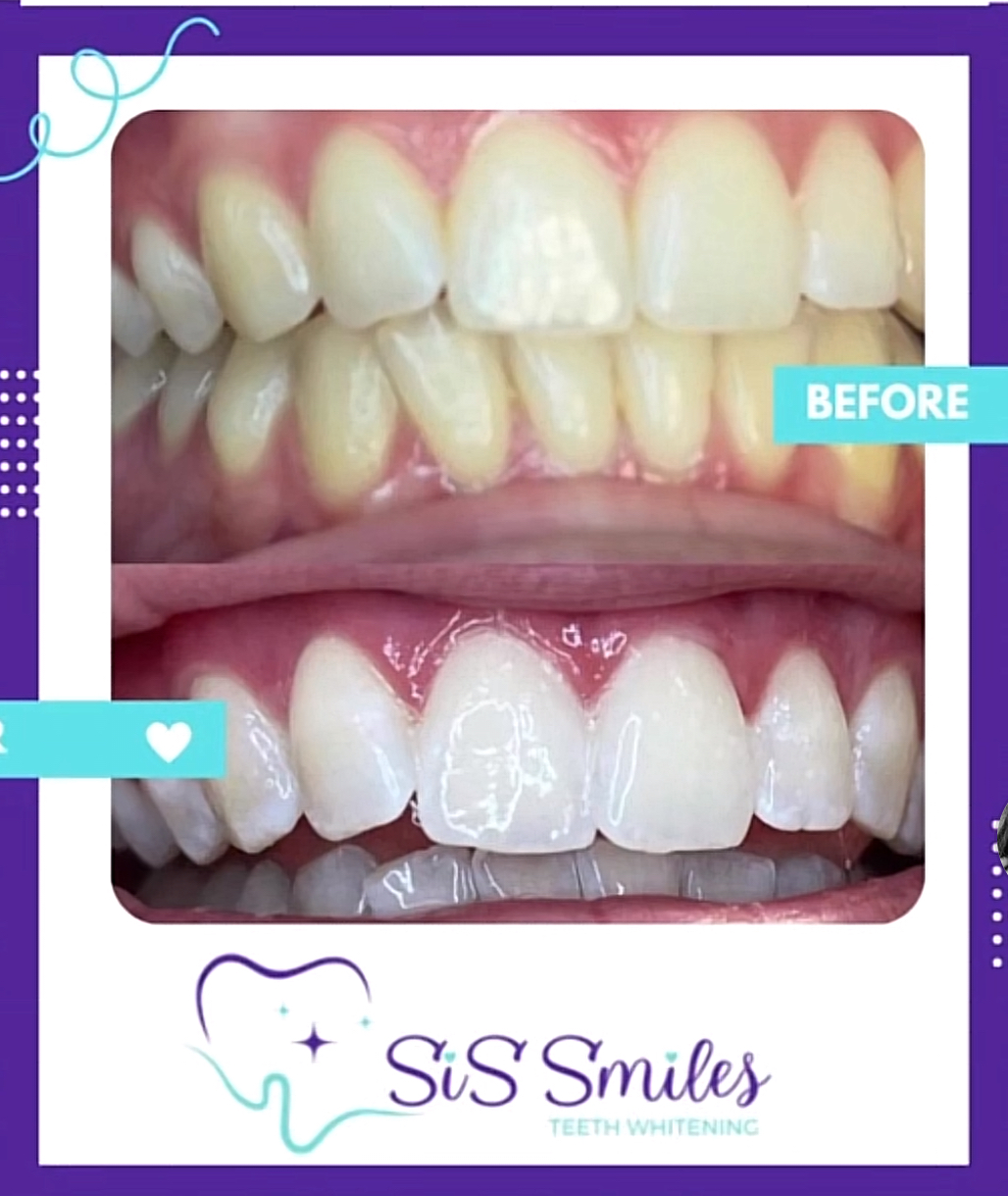Professional Teeth Whitening