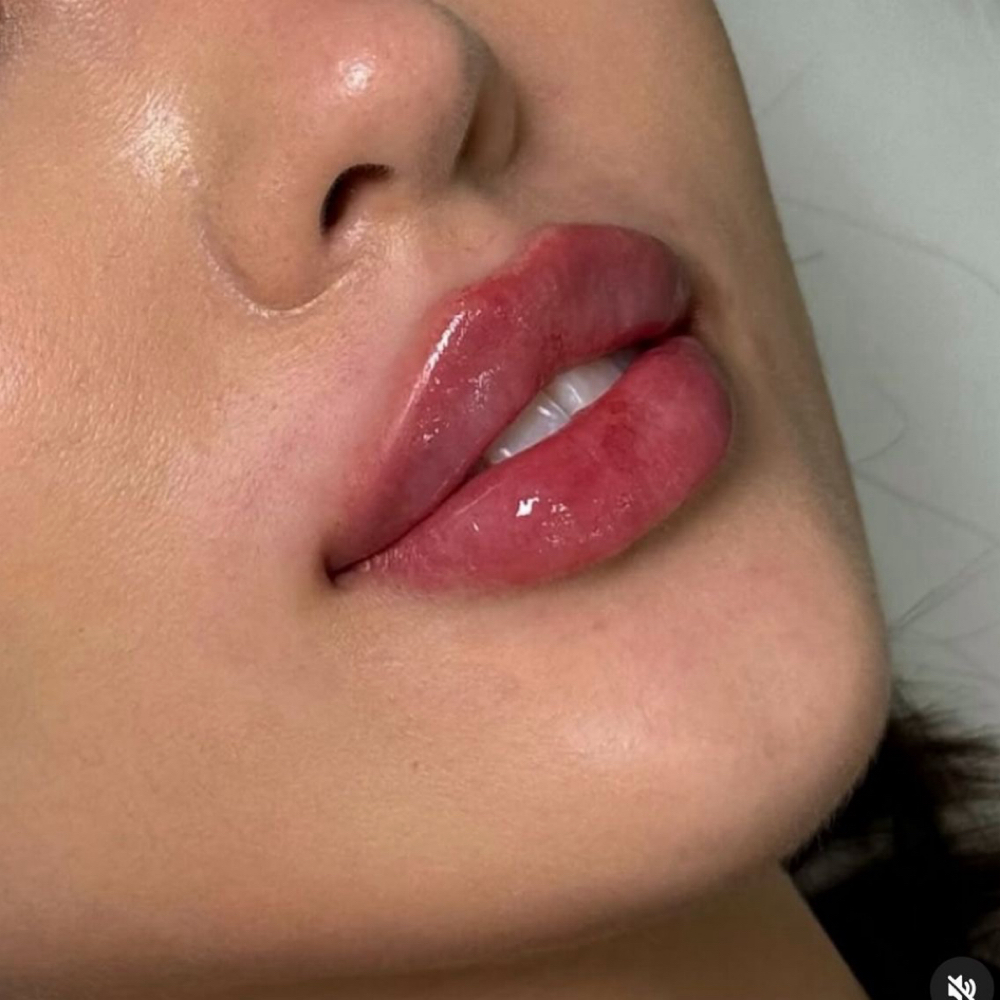 1 ml Lip Filler at Atlas Beauty Haven in Brownsville, TX
