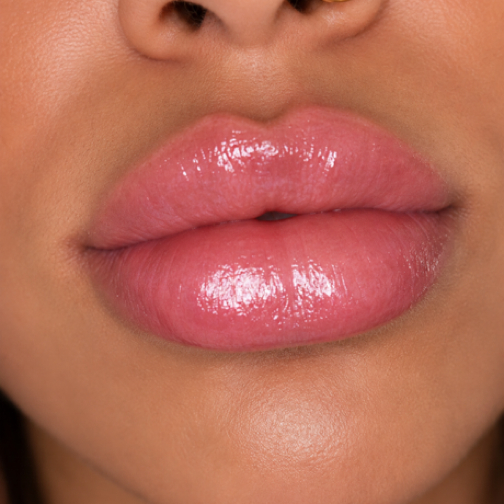 LIP FILLER 1ML at ELEVATED SKIN in Dallas, TX