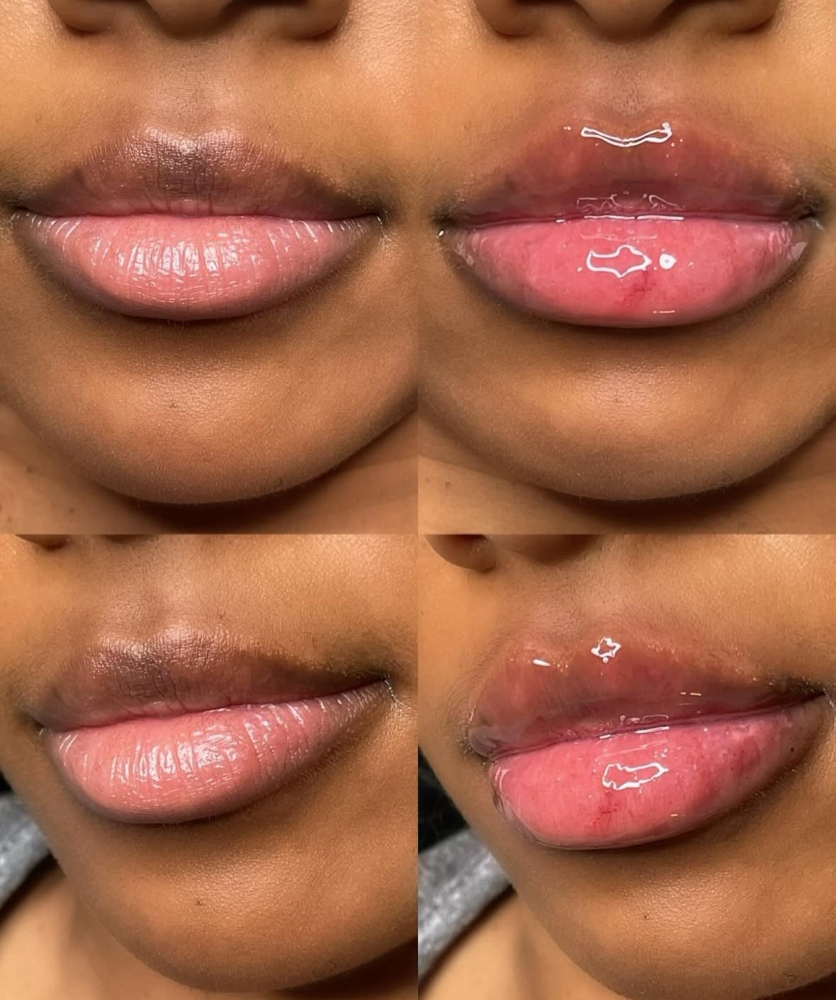 No Needle Lip Filler 1ML