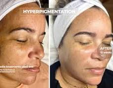 Cell Turnover Facial