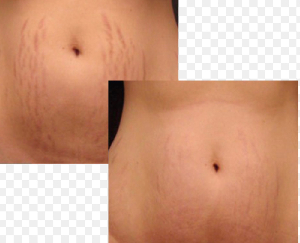 Stretch Mark Camouflage And Removal