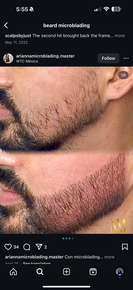 Beard Micropigmentation
