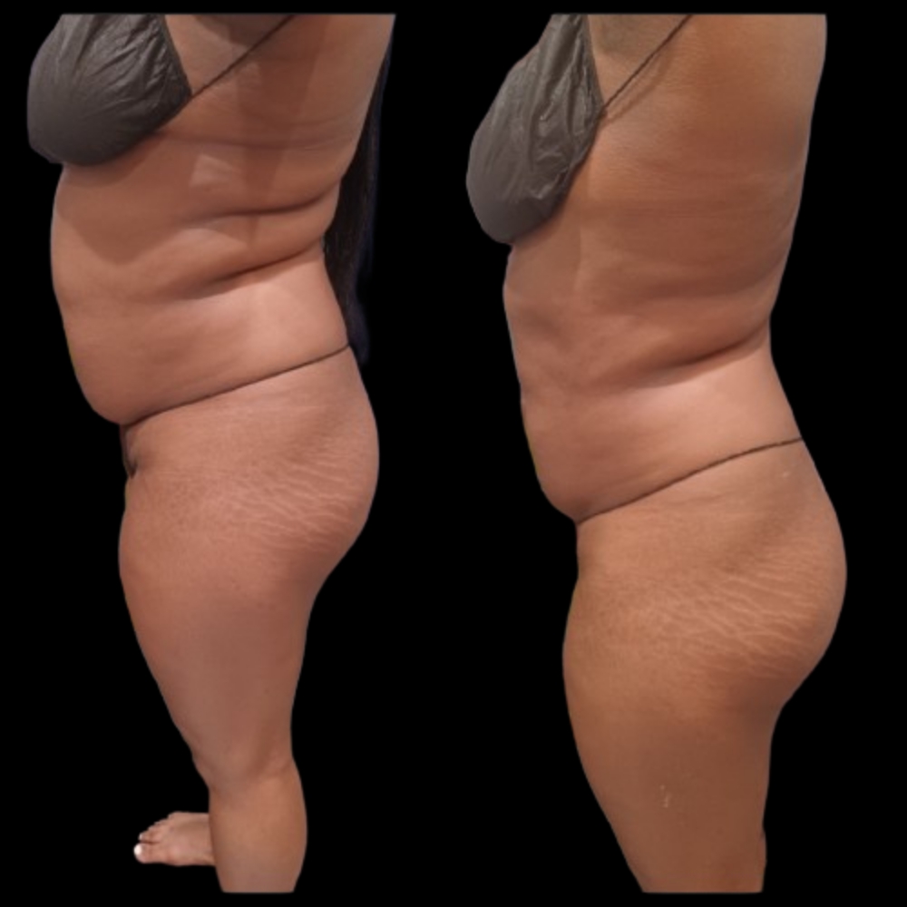 ✨6 Snatch & Lift Body Contouring ✨ at JUST BEAUTIFUL SKIN in Goose Creek, SC