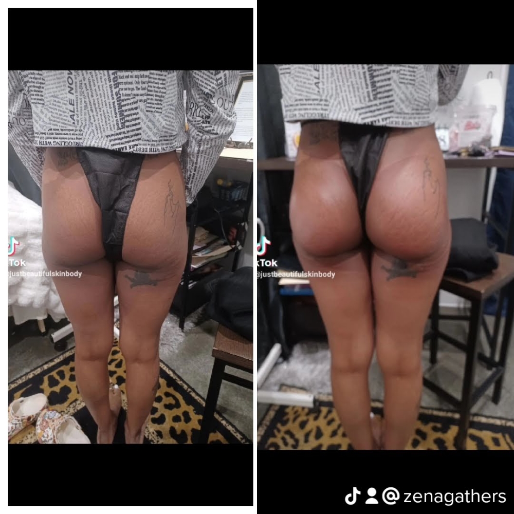 BOOTY🍑 Non-surgical 3 Session