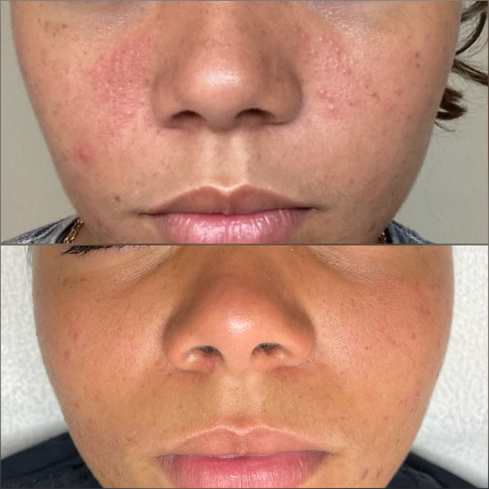 Clear Skin Treatment