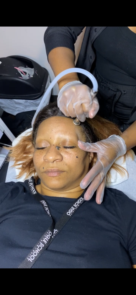 Microdermabrasion Facial
