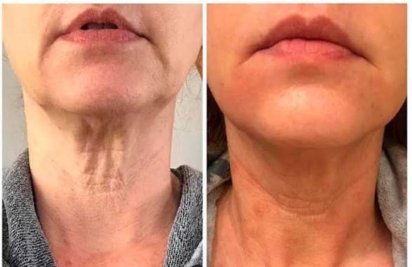 Hifu Neck at Natural Glow in Grand Praire, TX