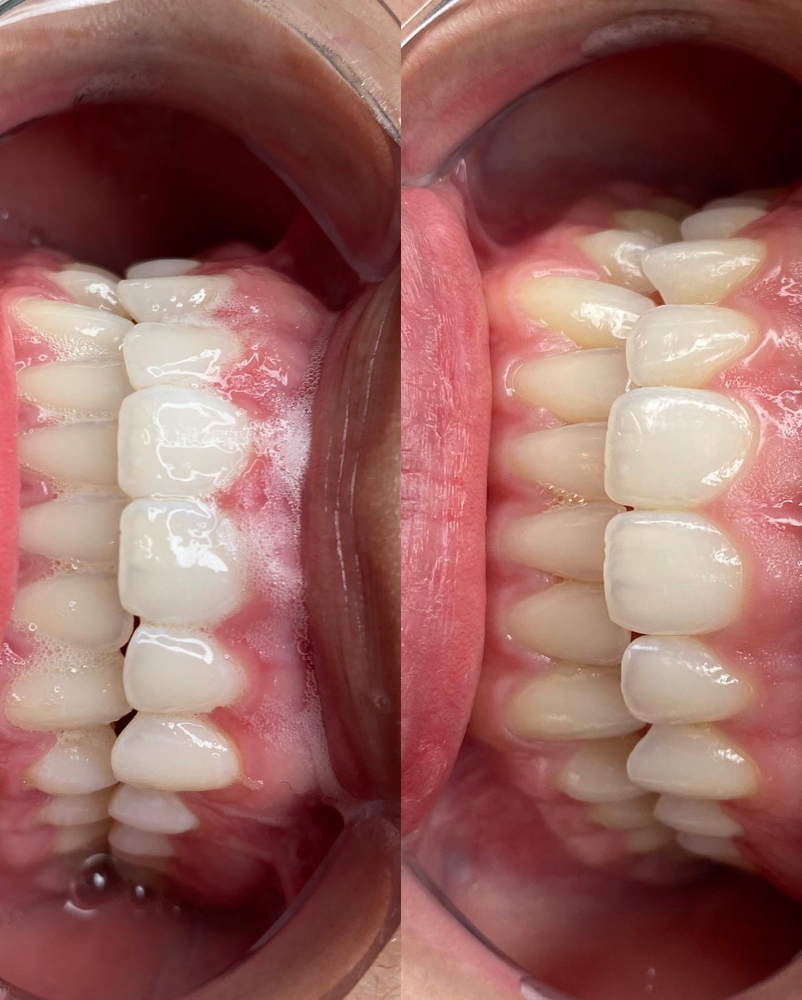 Blue Light Teeth Whitening Training