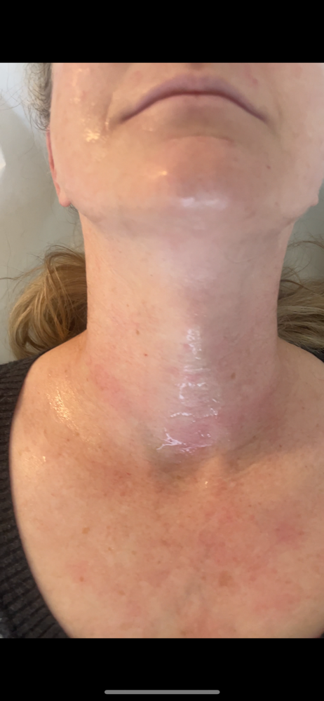 Radiofrequeny Skin Tightening