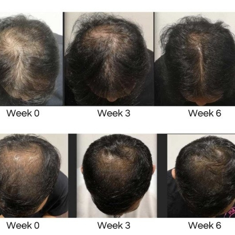 Calecim Hair Growth 6 Week In Salon at Serendipity Hair Studio in Knoxville, TN