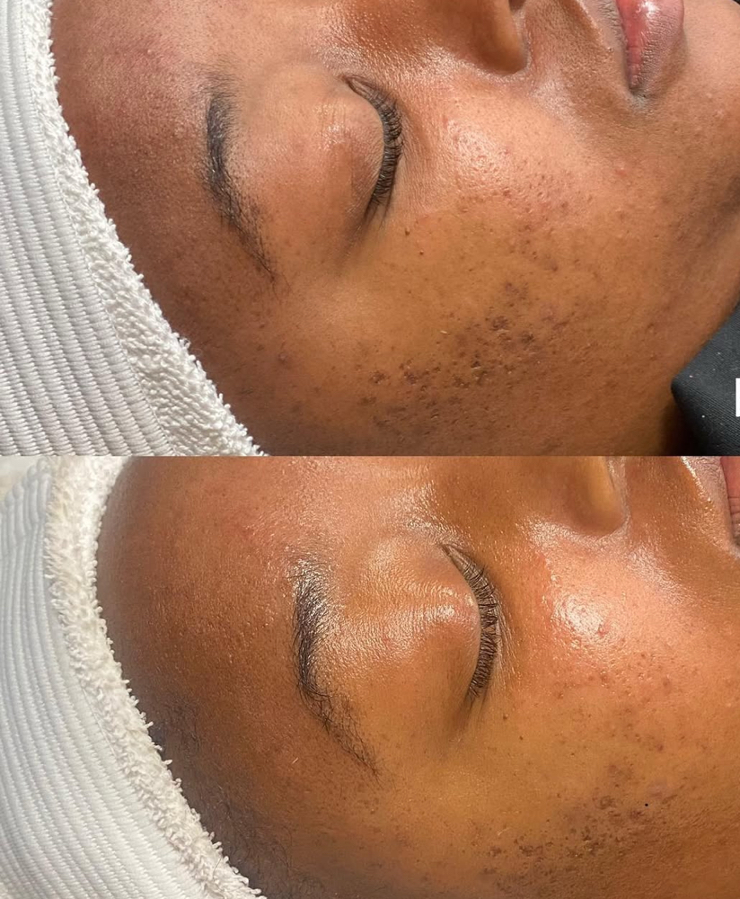 Acne Treatment