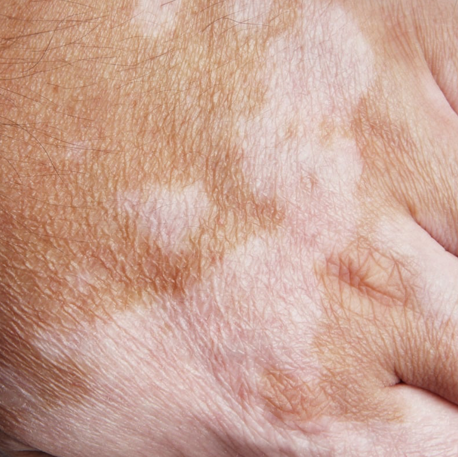 Vitiligo Camouflage Tattoo