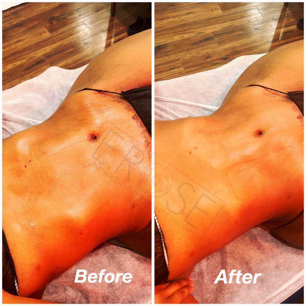 Post-Op Lymphatic Drainage Full Body at E Rose Health Wellness Holistic Therapy in Southfield, MI