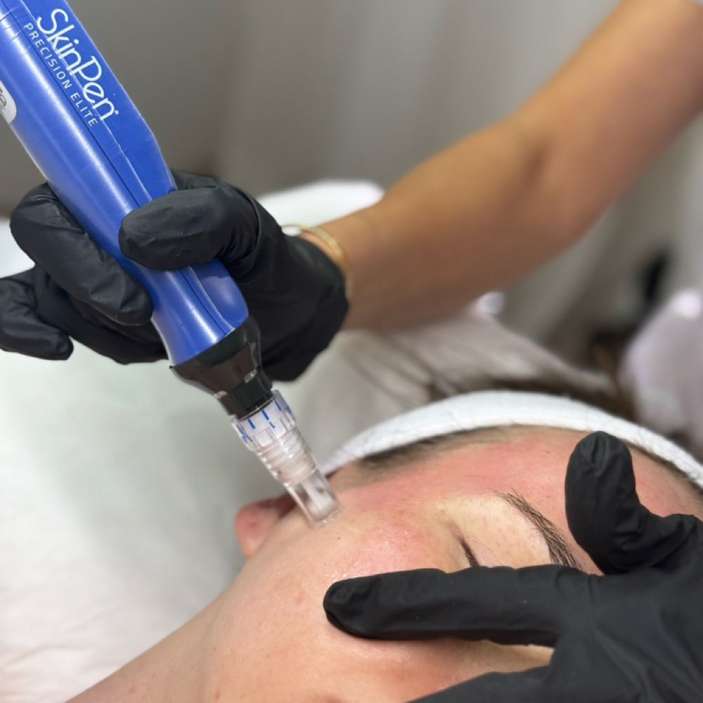 SkinPen Face & Neck at DermAdi Skin in Houston, TX