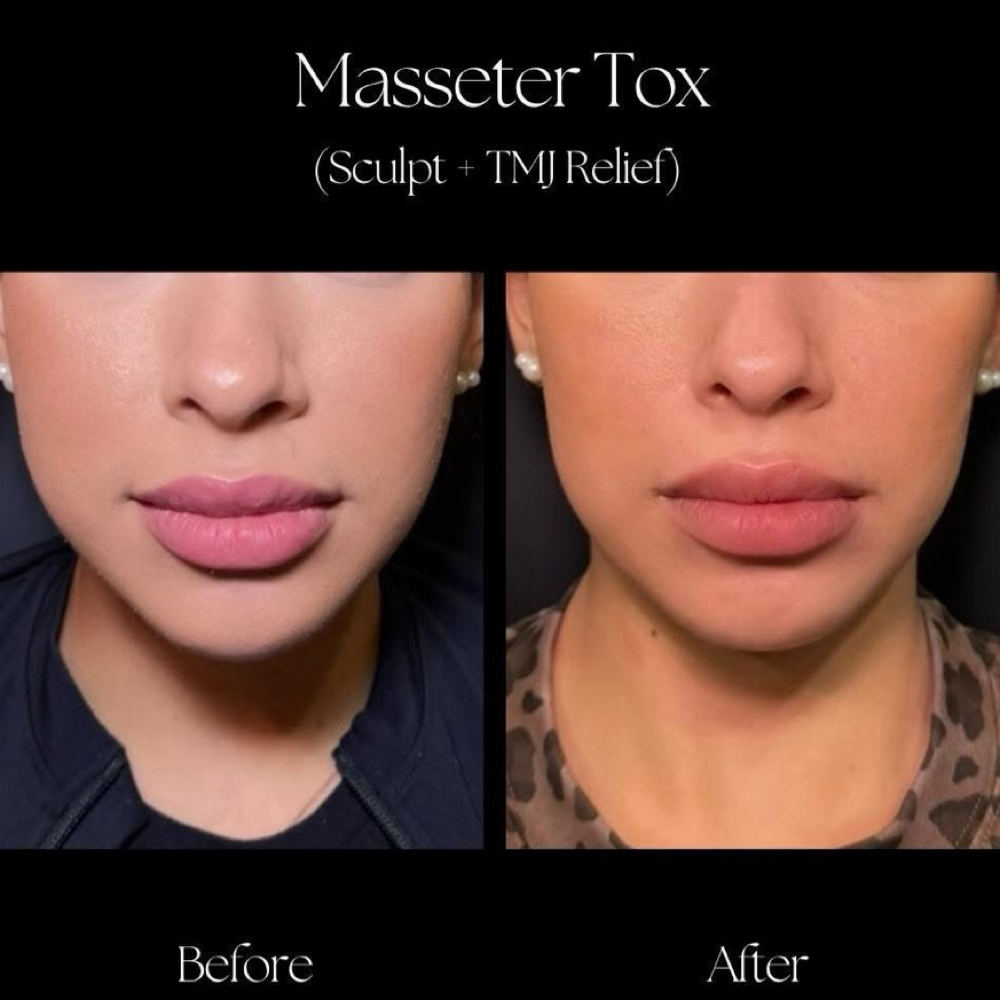 Signature Tox Enhancments at Infinity Aesthetics in Elsa, TX