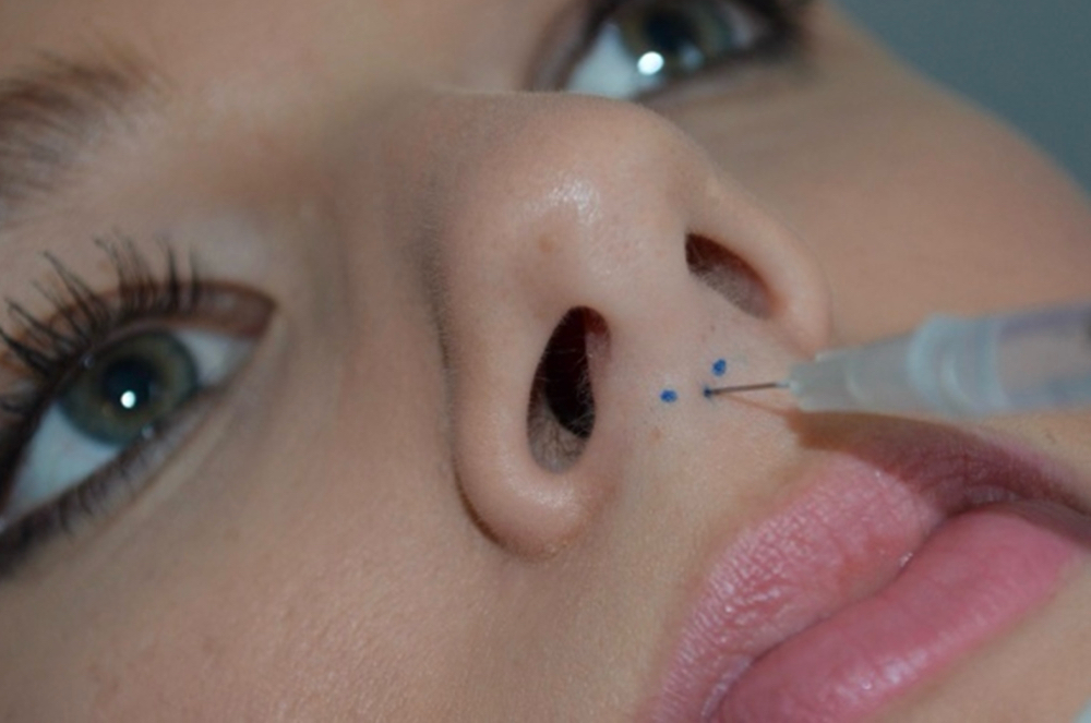 Tox Nose Tip Lift
