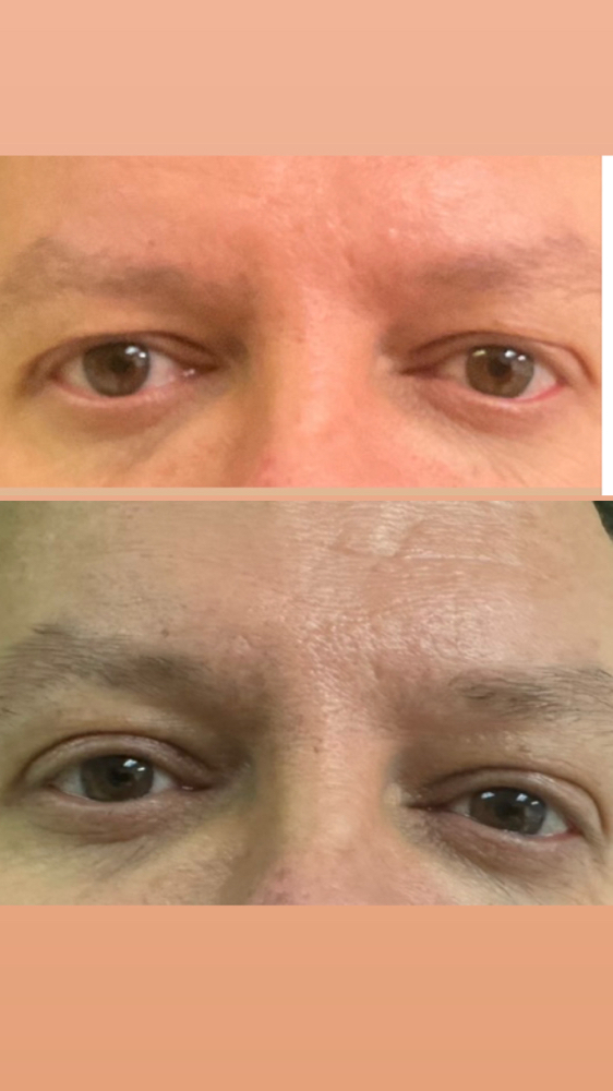 Plasma Eye Lift