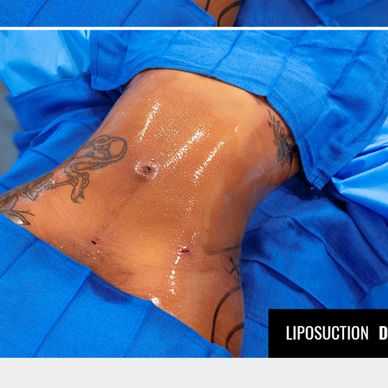 Post -Op Lymphatic Massage at Aesthetic Healing Massage in Minneapolis, MN