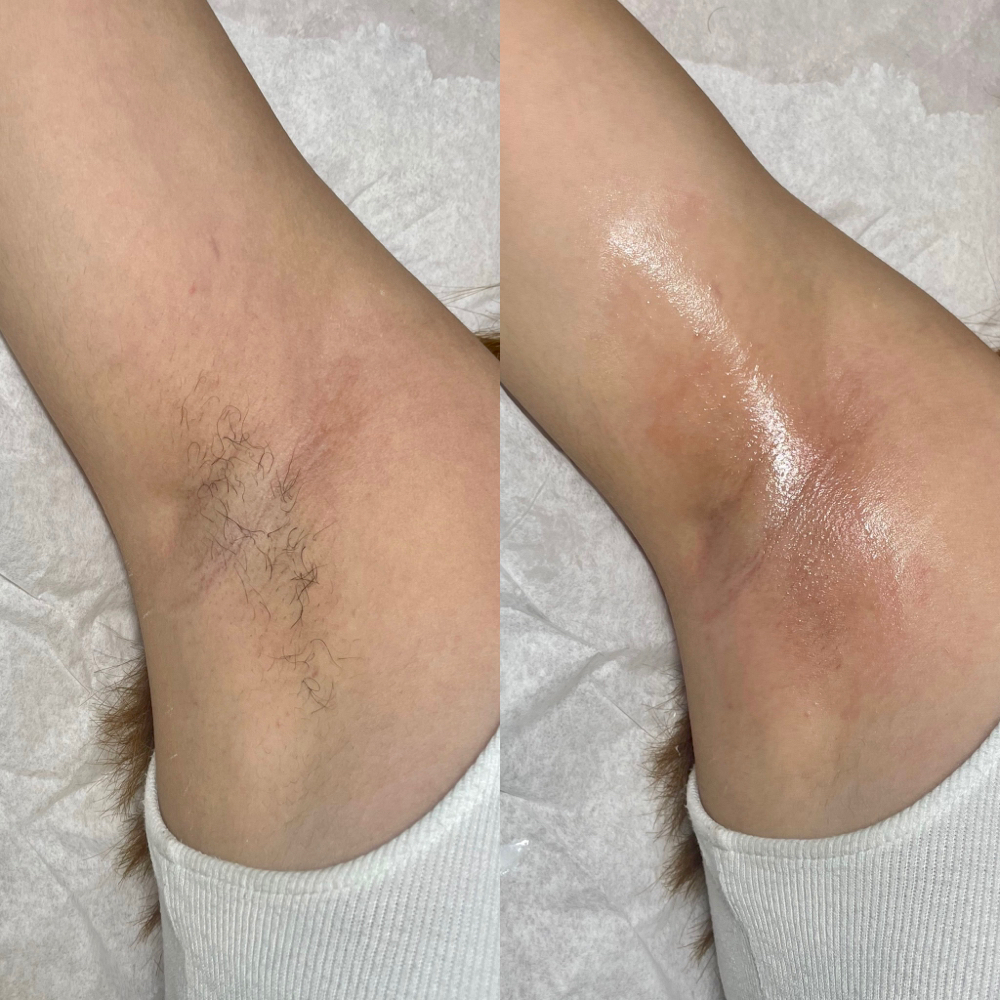 Underarm Wax