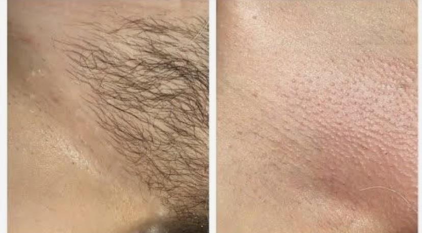 Brazilian Waxing