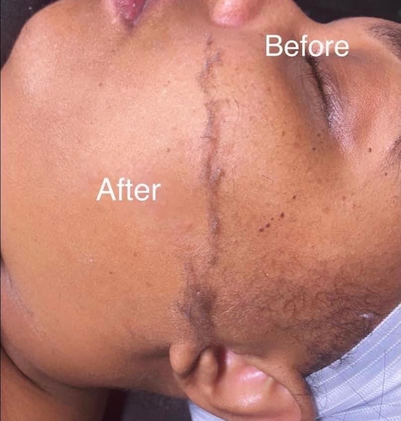 Dermaplane Facial