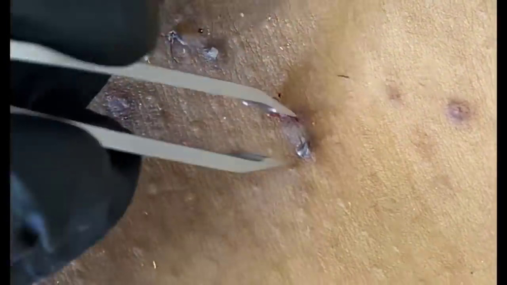 Extractions (Add On)