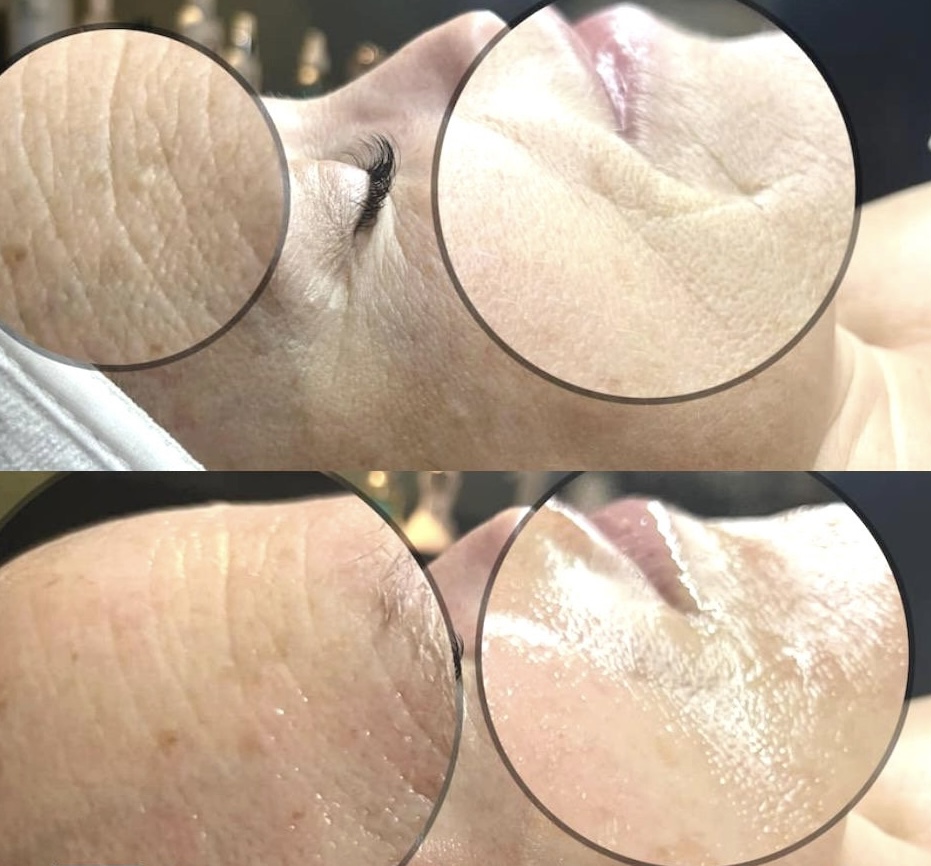 Beyond Botox Facial