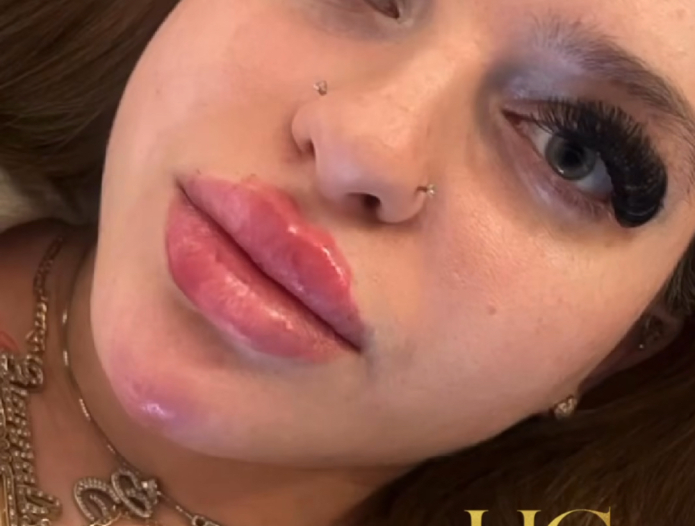 Lip Filler