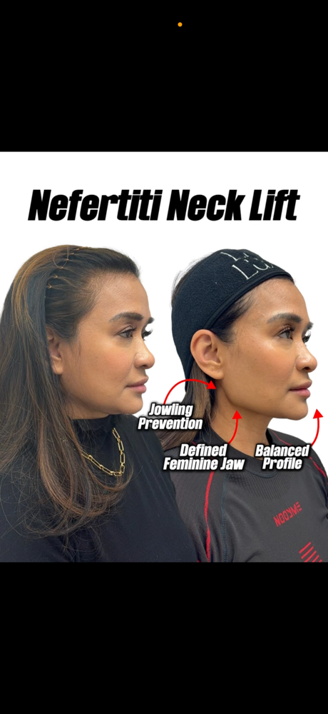 Nefertiti Neck Lift With Jeuveau