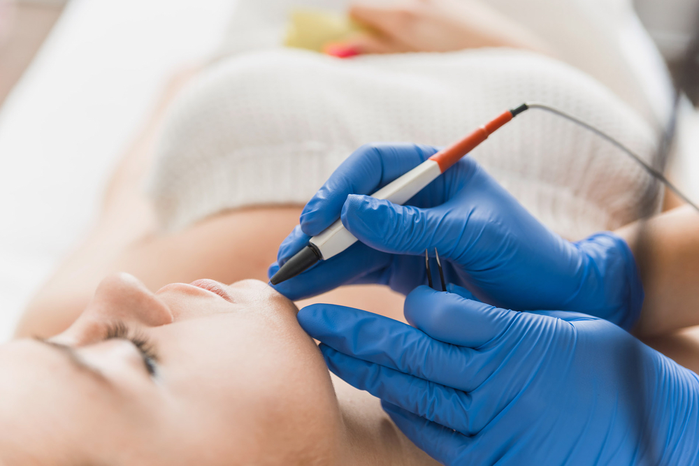 Permanent Hair Removal