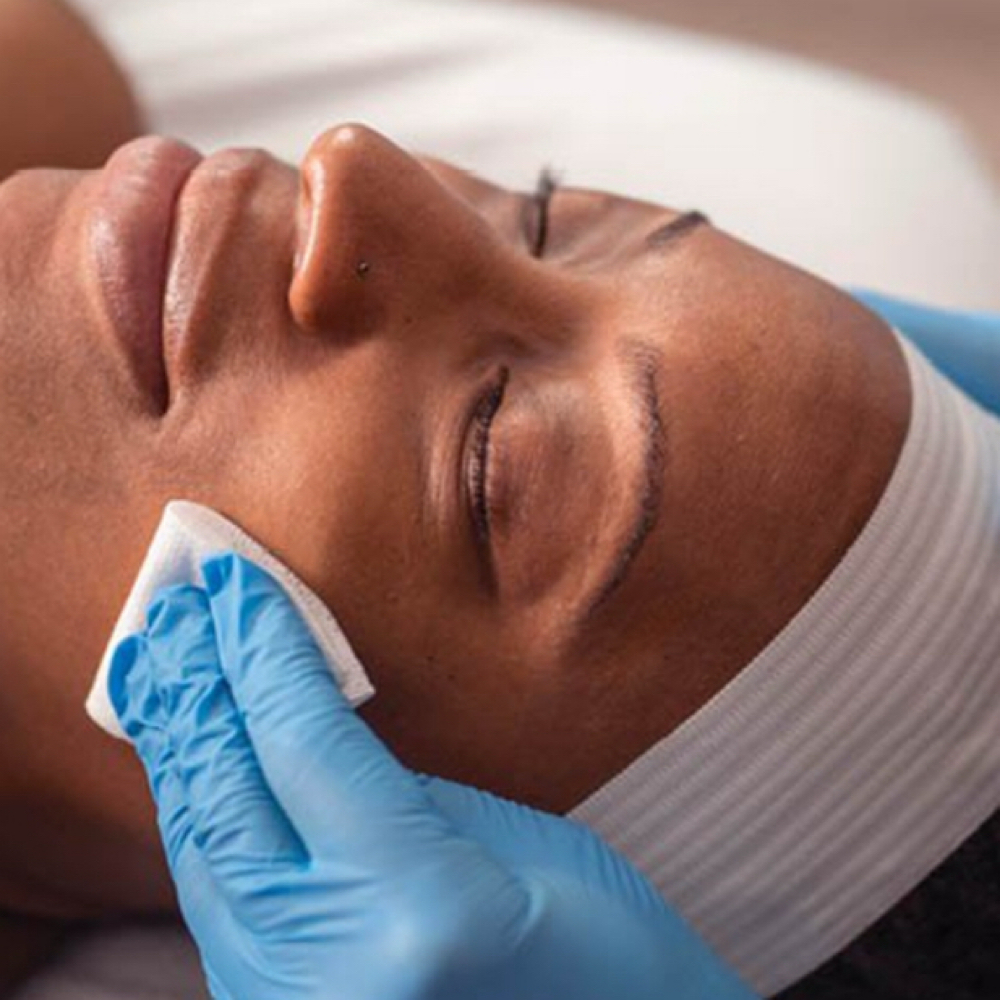 Customized Chemical Peel at Esthetics by Kira in Redding Ca, CA