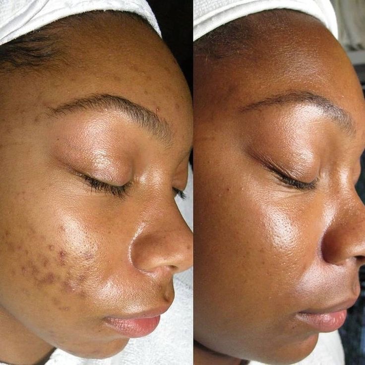 Bye Bye Zits Facial