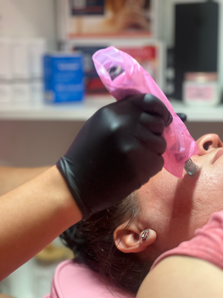 Microneedling +Salmon DNA