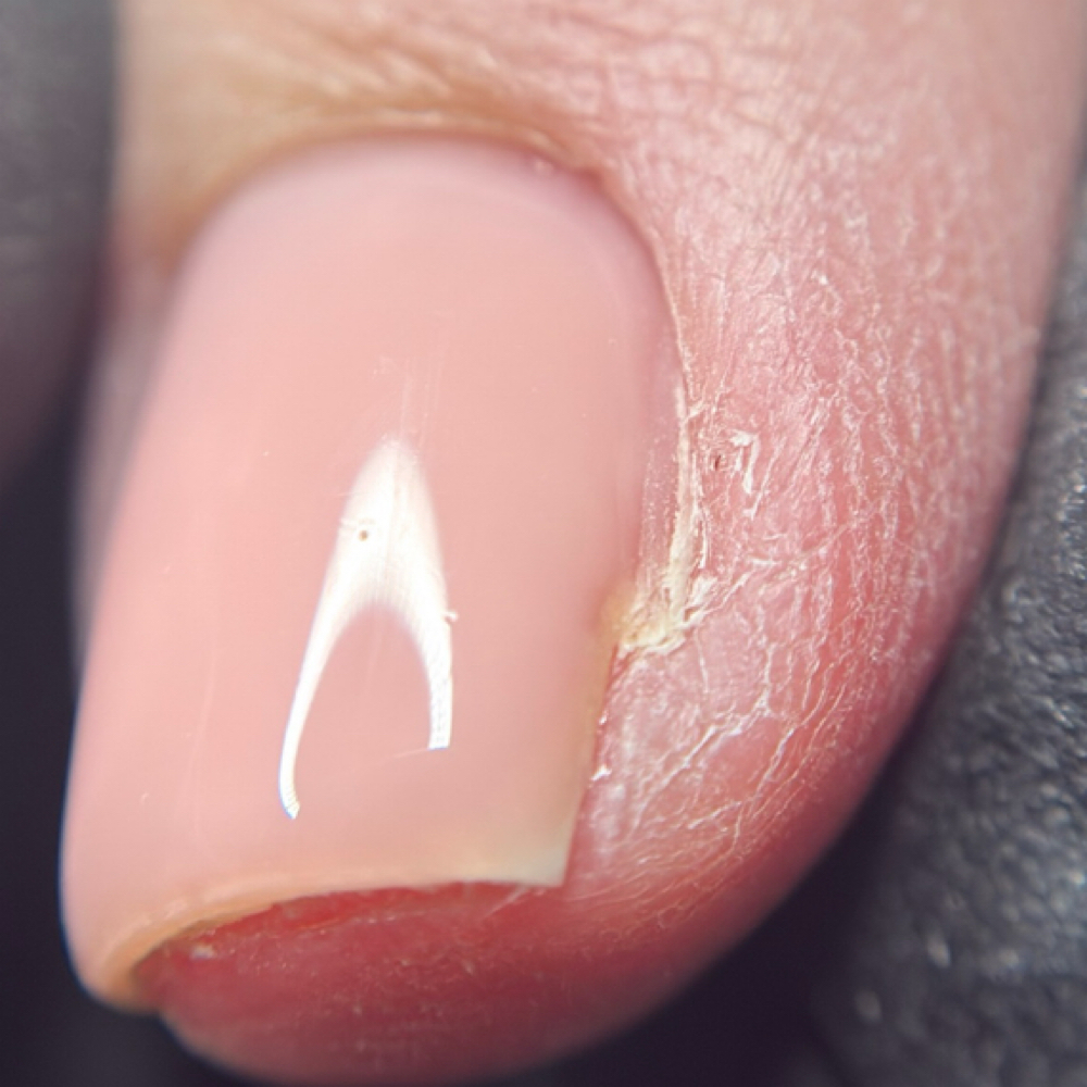 Nail Correction at Sarah Montelongo in Valley Center, KS