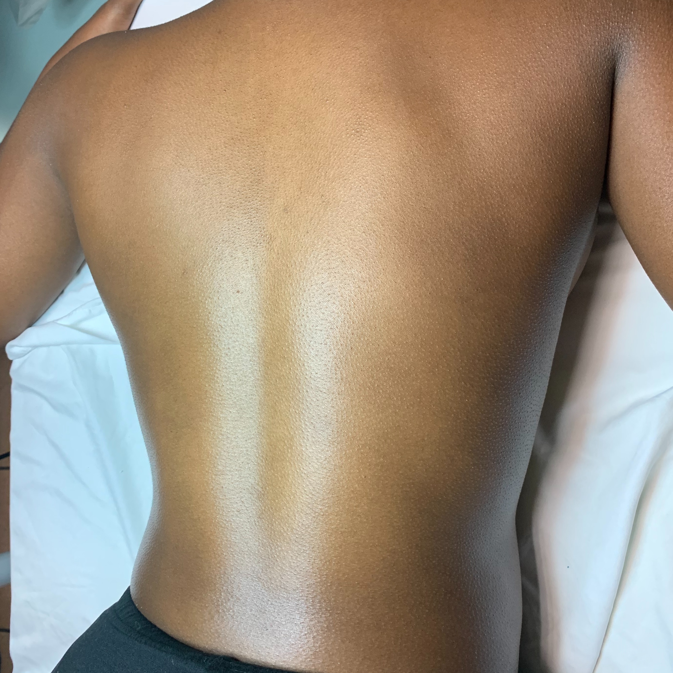Corrective Back Treatment at Velnaira in Lakewood, CA