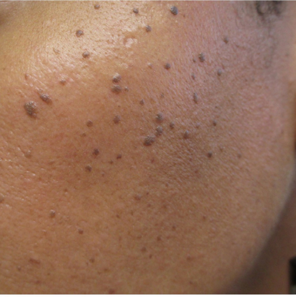Up to 10 Lesions (DPN, Skin Tags) at The Art of Glow by Chelle in New York, NY