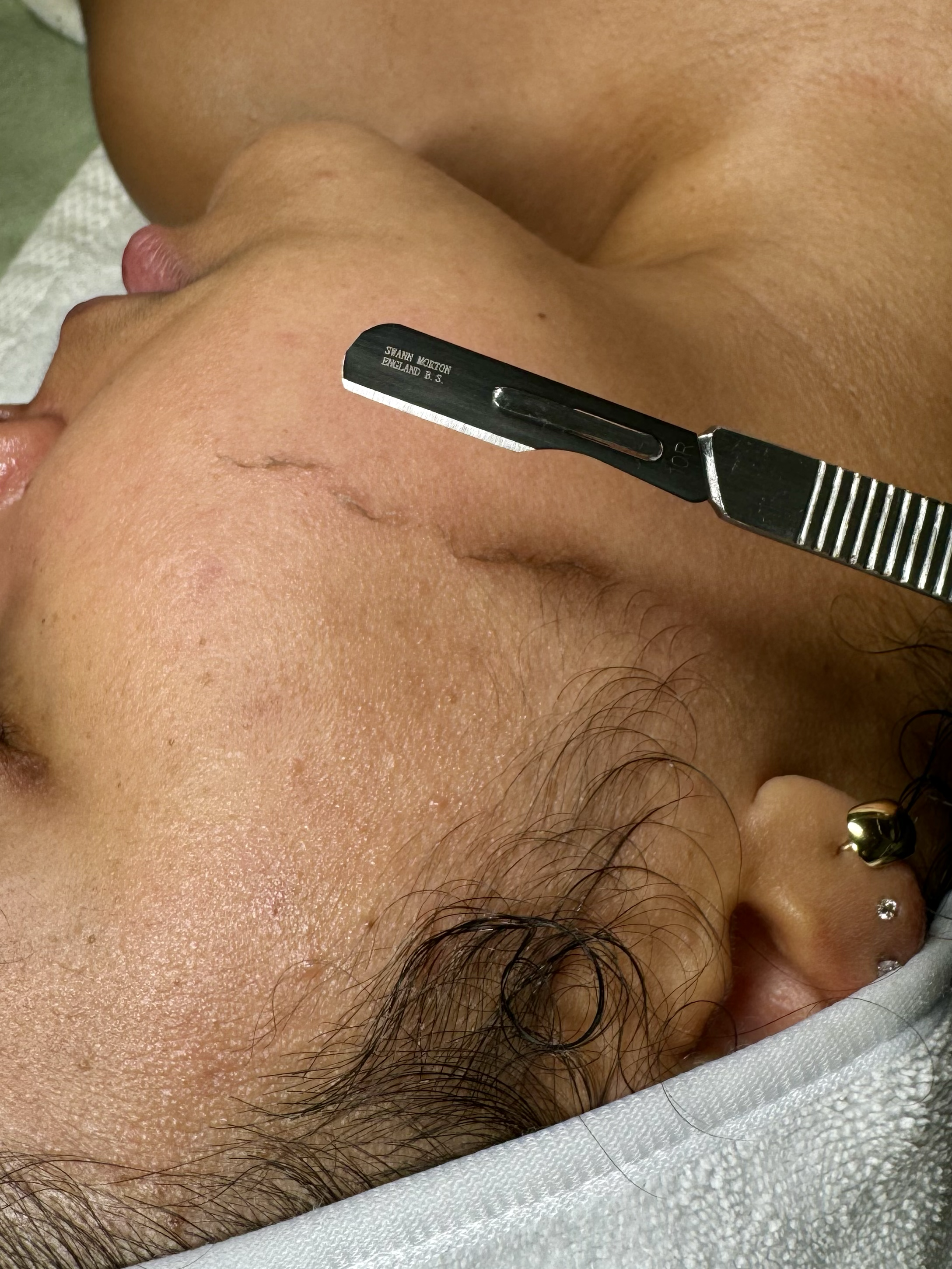 Dermaplaning Facial