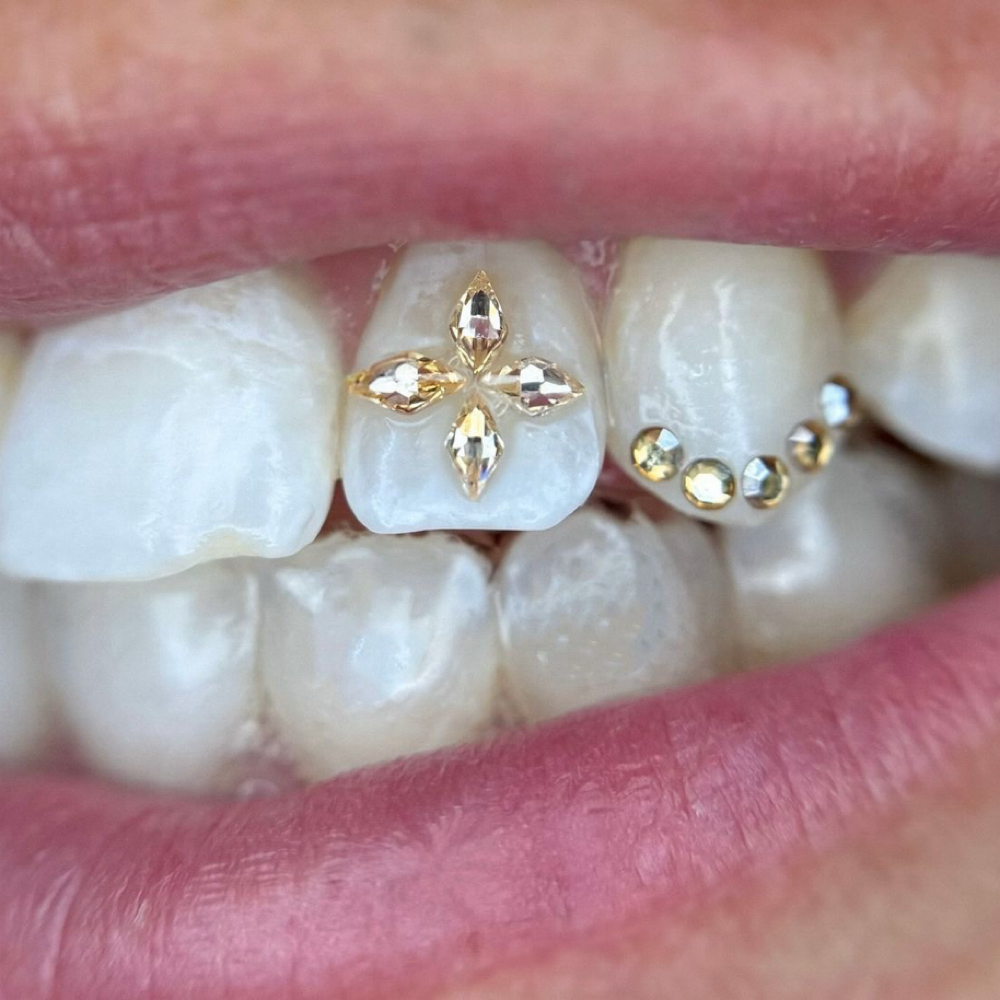 6-10 Tooth Gem Design at Ice Queen Whitening in Hillsboro, OR