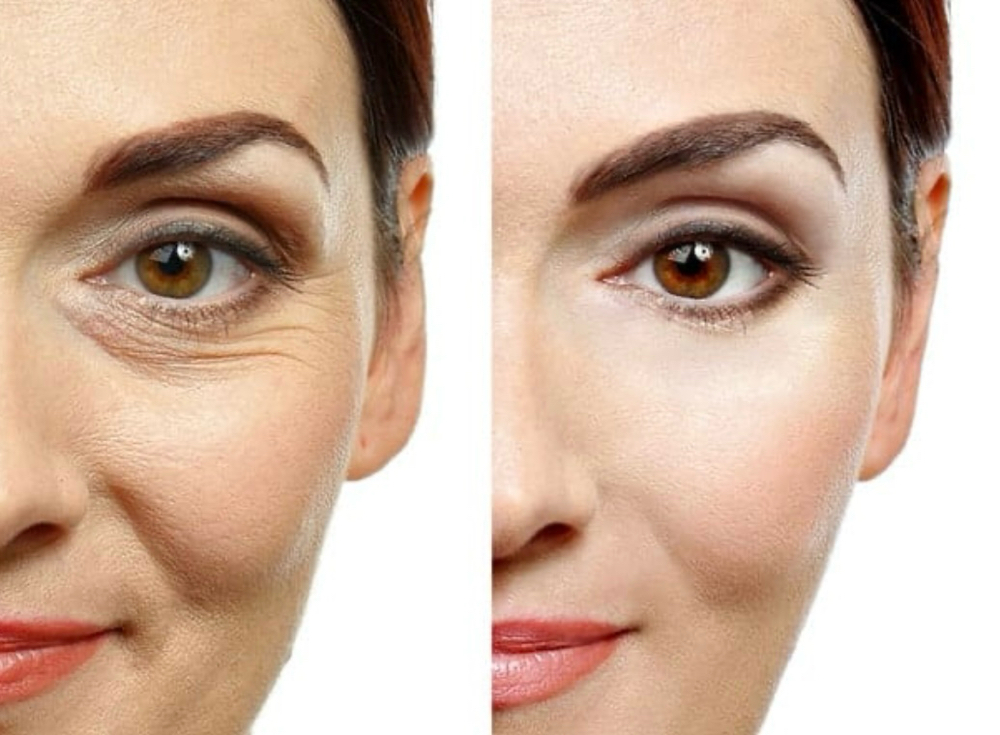 Collagen Facial