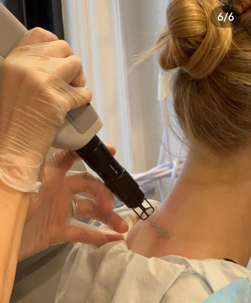 Tattoo Removal