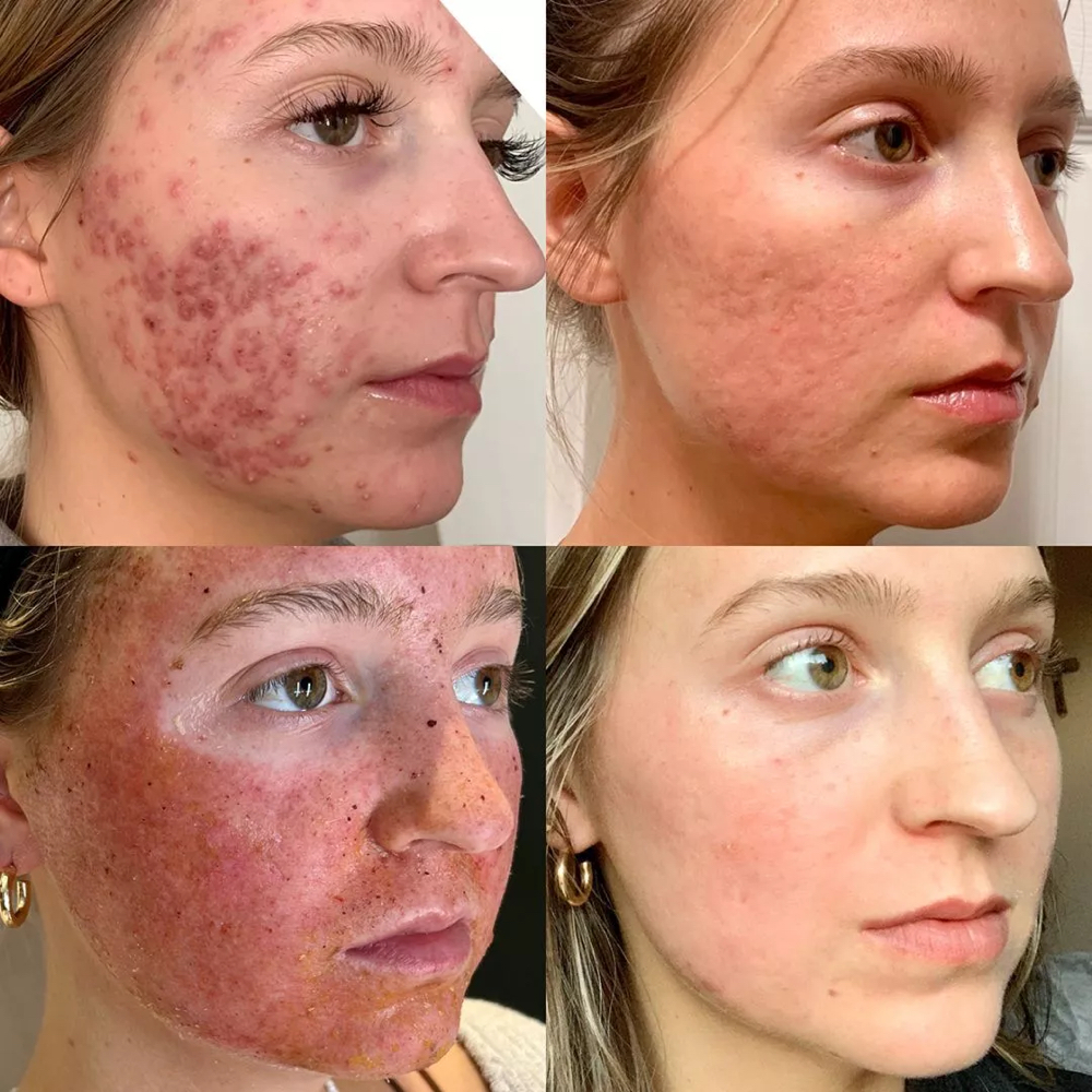 Acne Scar Rejuvenation